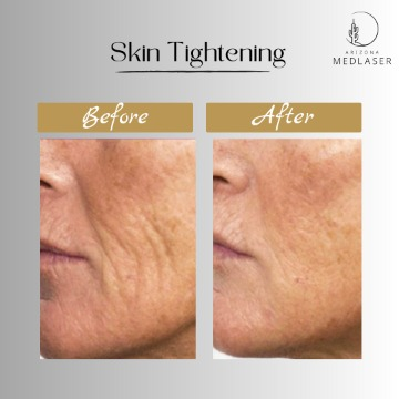 Arizona MedLaser skin tightening before and after, cheek wrinkles