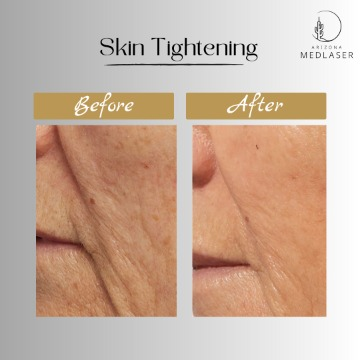 Arizona MedLaser skin tightening before and after, lines around the mouth