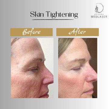Arizona MedLaser skin tightening before and after, facial profile